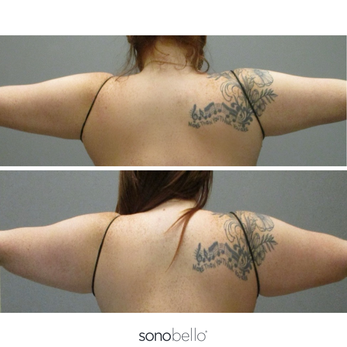 Sono Bello Arm Liposuction Before and Afters