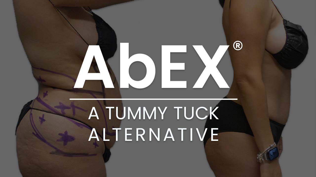 AbEX Tummy Tuck Alternative before and after photo