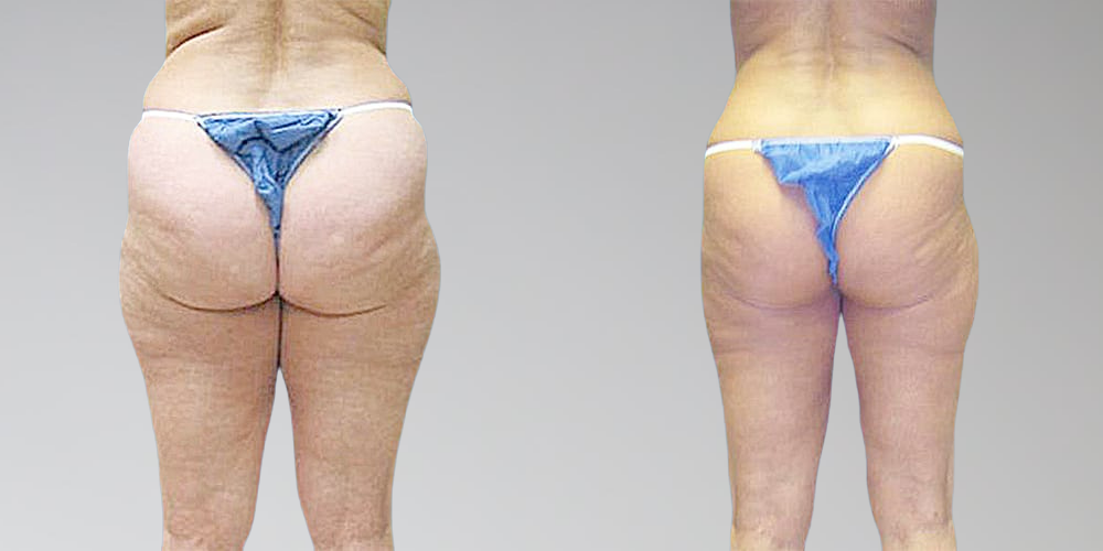Leg fat removal before and afters