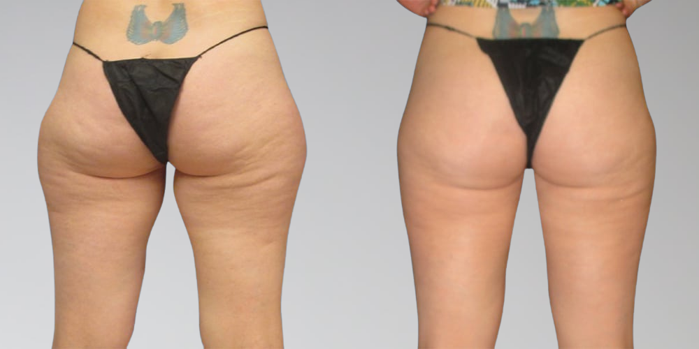 Before and After leg liposuction at Sono Bello