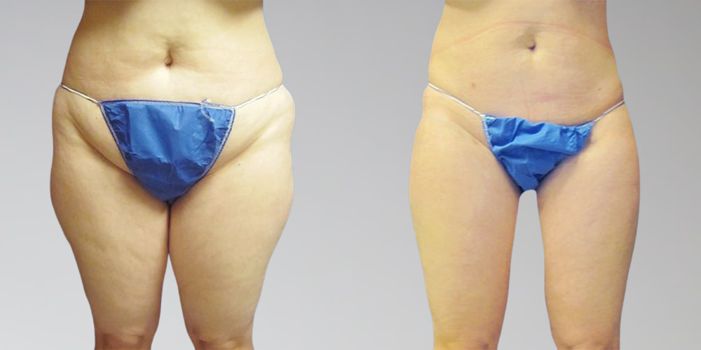 Liposuction results for legs