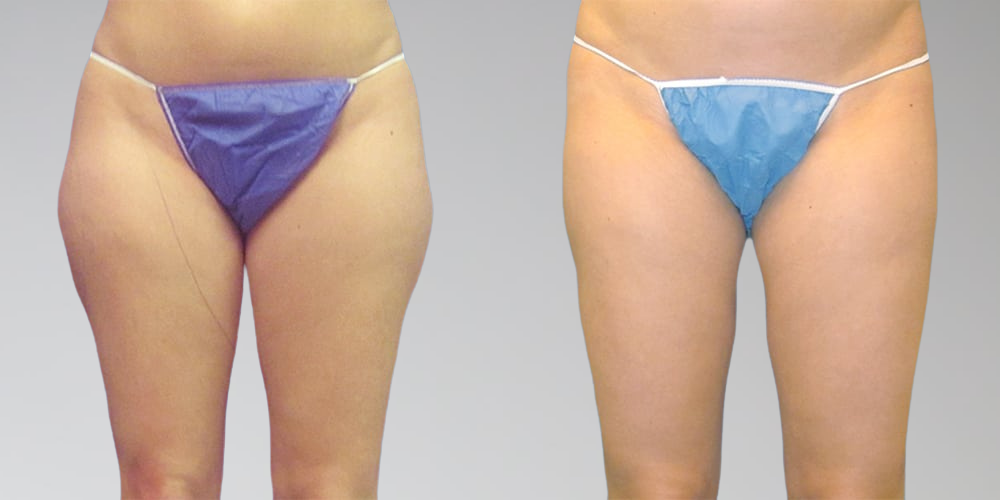 Legs before and after liposuction