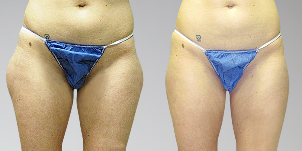 Leg liposuction before and after results