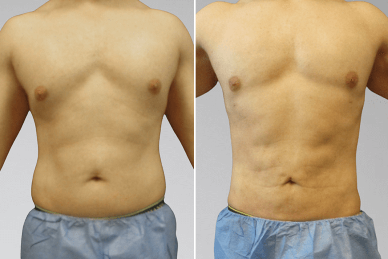 Male Express Abs