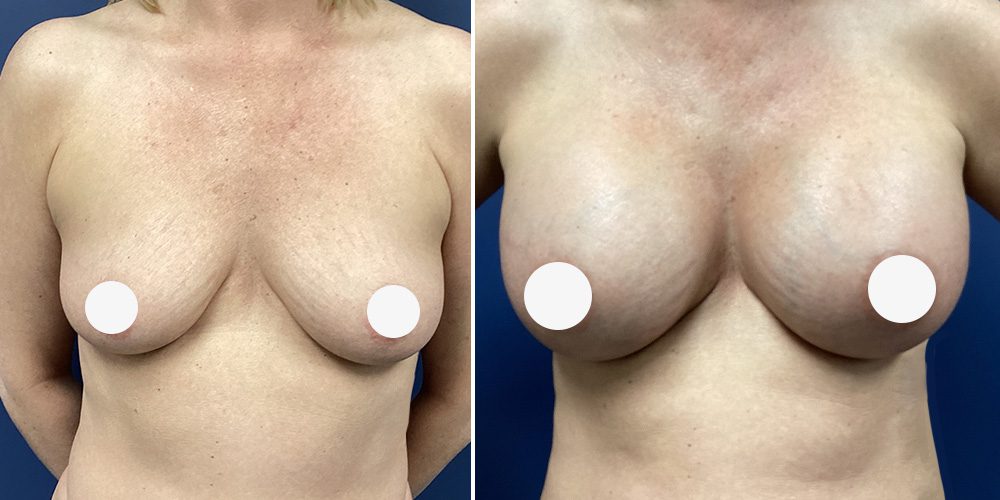 Breast augmentation results at Sono Bello