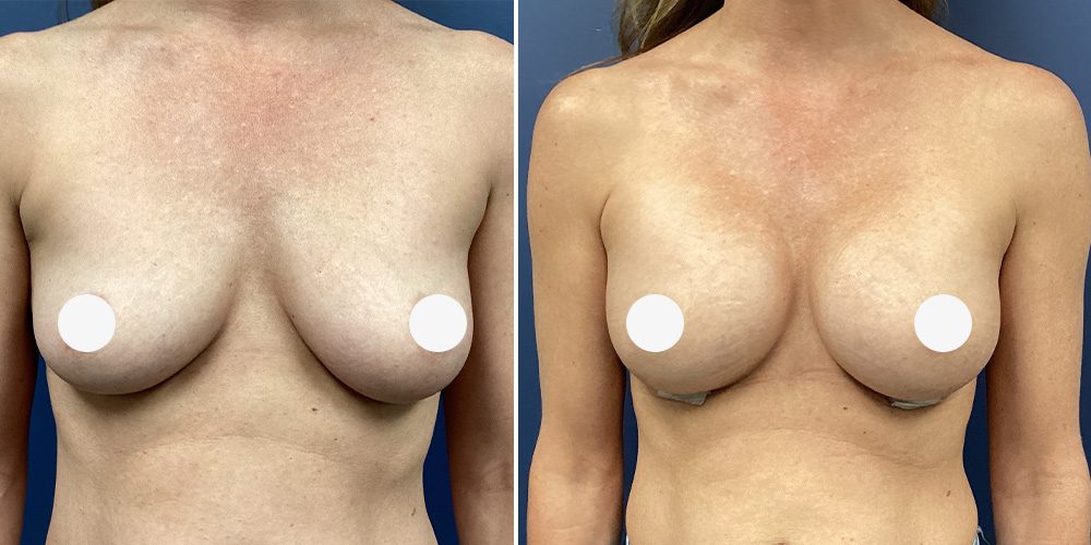 Sono Bello Contour breast augmentation results