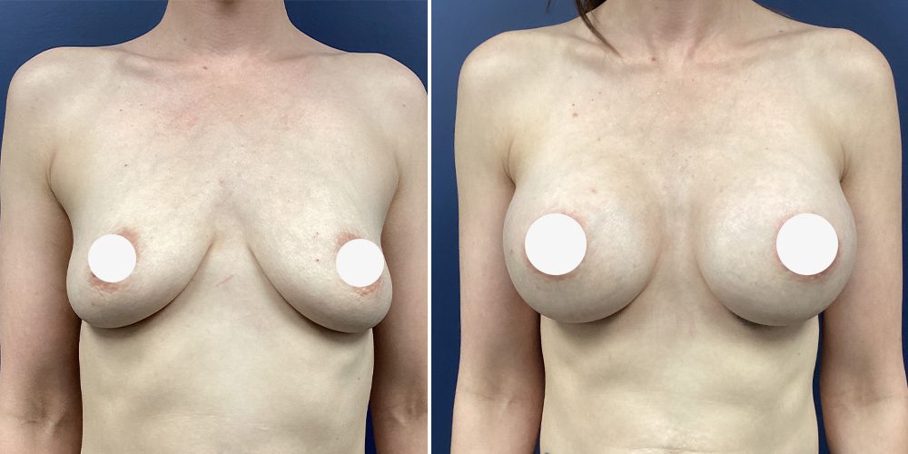 Sono Bello Contour breast augmentation before and after