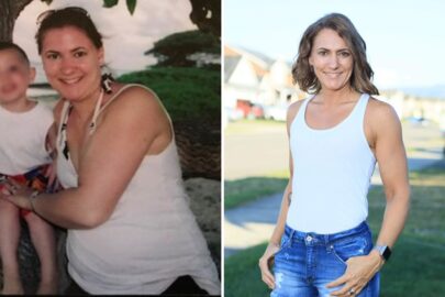 B'Ann before and after Sono Bello liposuction