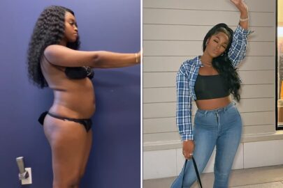 Taylor before and after liposuction at Sono Bello Dallas