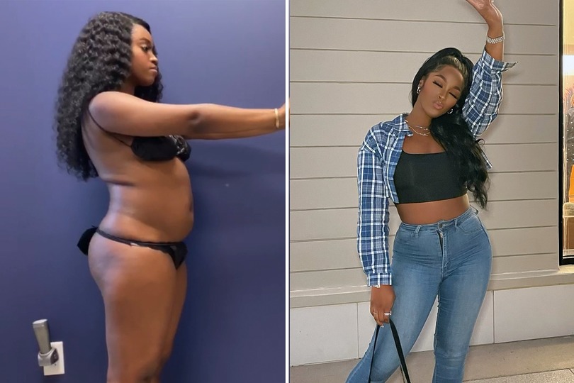 Taylor before and after liposuction at Sono Bello Dallas