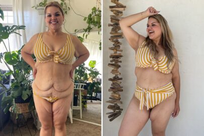 Ashley poses in yellow bikini showing AbEX excess skin removal before and after results