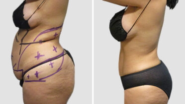 Side-profile of a patient before and after their liposuction procedure at Sono Bello