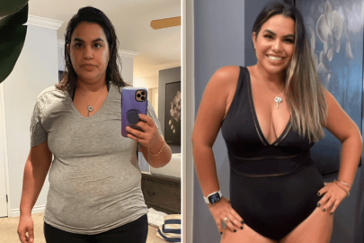 Adrian mommy makeover before and after results
