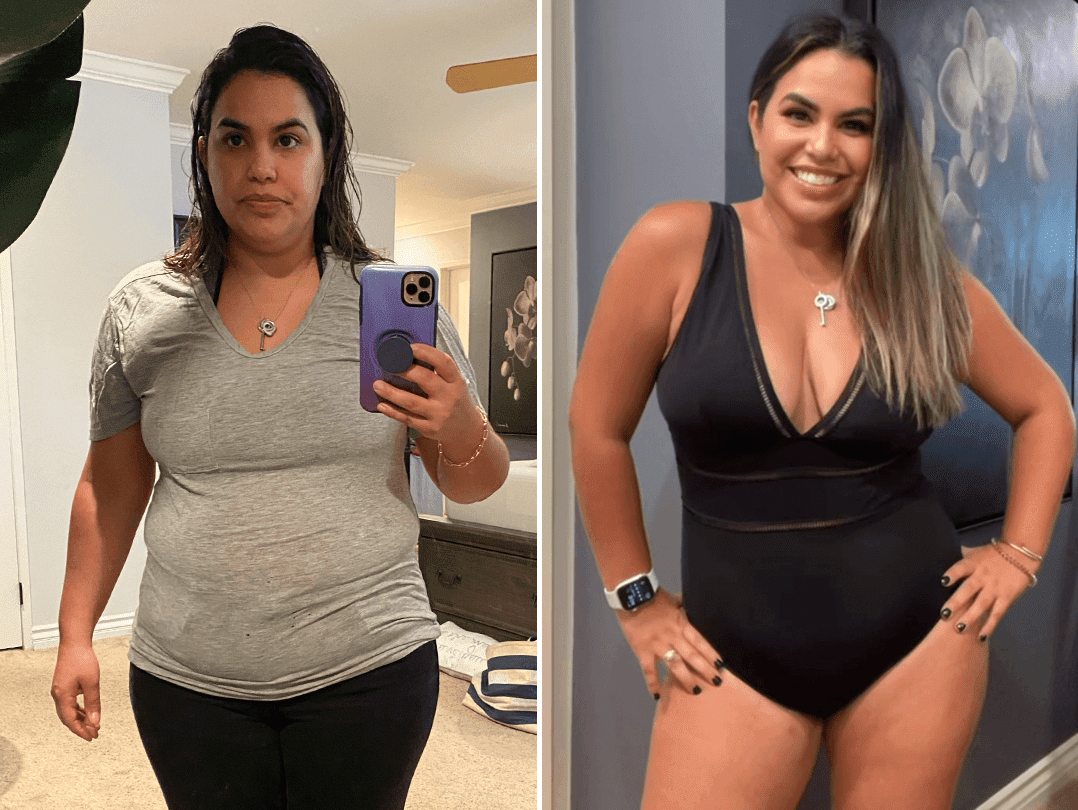 Adrian before and after a Sono Bello mommy makeover to remove loose skin after pregnancy