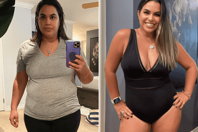 Adrian before and after a Sono Bello mommy makeover to remove loose skin after pregnancy