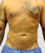 Male after liposuction at Sono Bello