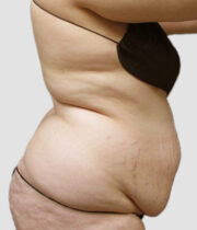 Side-profile of woman before liposuction at Sono Bello