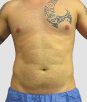 Male before liposuction at Sono Bello