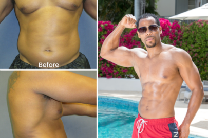Jarrett's Sono Bello liposuction results before and after