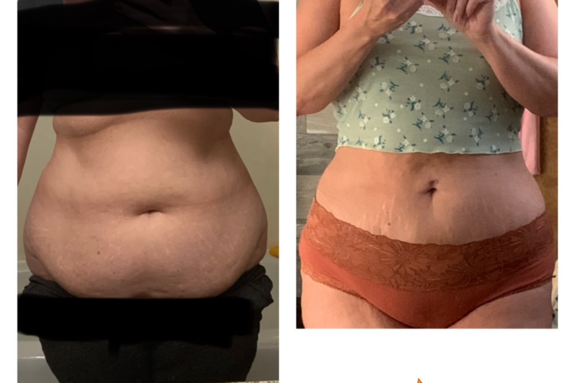 Before and after comparison of body transformation with Sono Bello, showing significant weight loss and body contouring results.