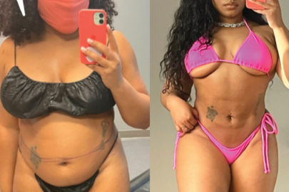 Olivia before and after liposuction transformation