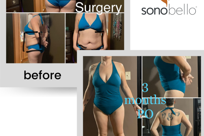 Before and after surgery comparison featuring a person in blue swimwear with Sono Bello logo.