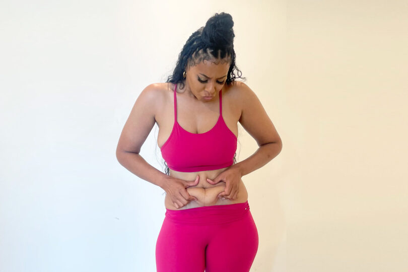 Vanessa Simmons before liposuction at Sono Bello