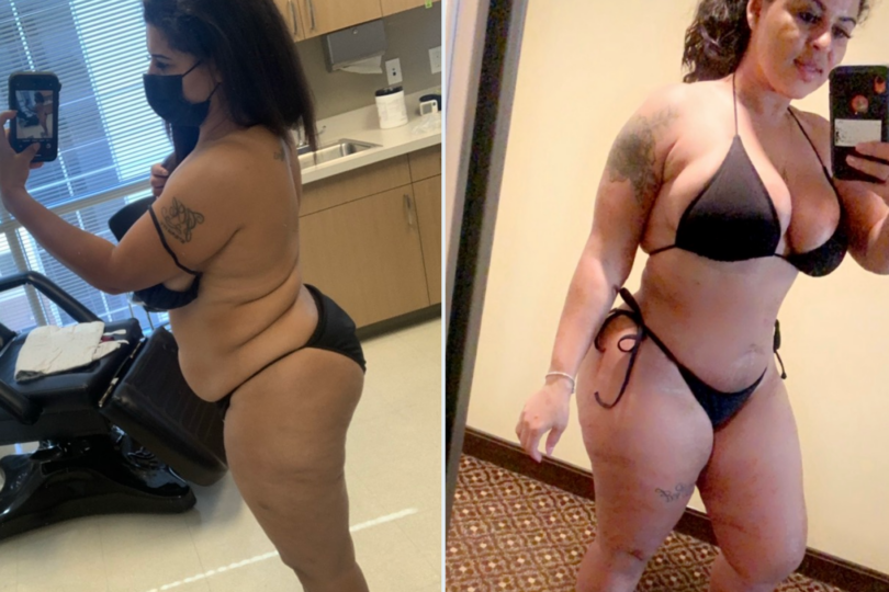 Before and after photos of a woman showing body transformation in a medical setting and in a bikini indoors.