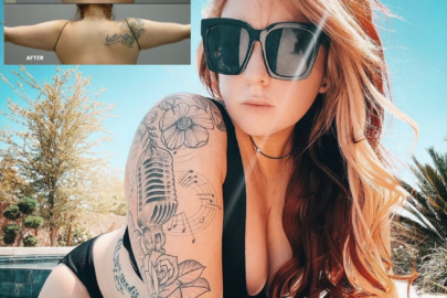 Heather before and after liposuction results