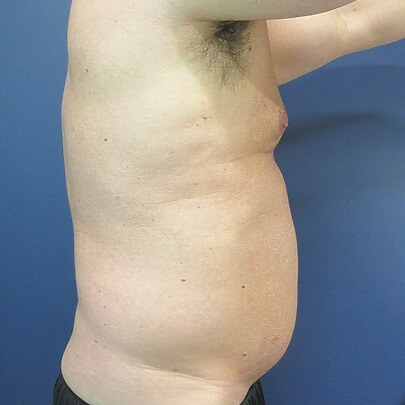 Male patient before stomach liposuction at Sono Bello