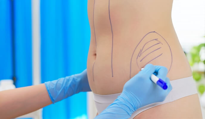 Determining the number of treatment areas for liposuction