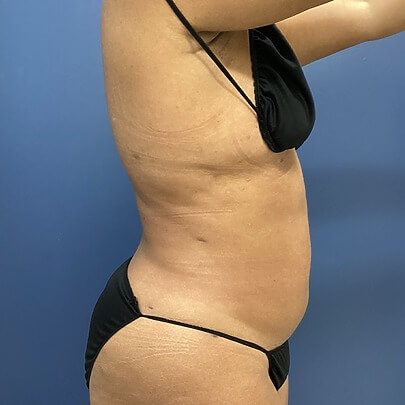 Patient side-profile after laser liposuction procedure