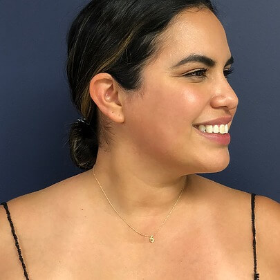 Sono Bello patient smiling after chin liposuction