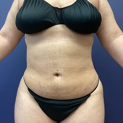 After Sono Bello Liposuction