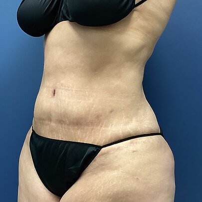 Sono Bello patient after weight loss procedure