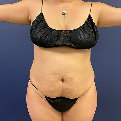 Before Laser Liposuction at Sono Bello