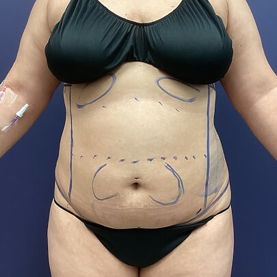 Before Sono Bello Liposuction