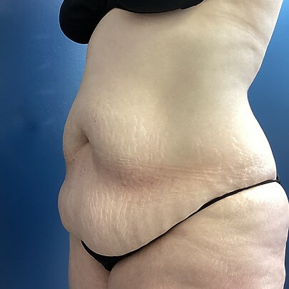 Sono Bello patient before weight loss procedure