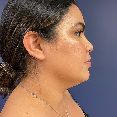 Sono Bello patient side profile before chin liposuction