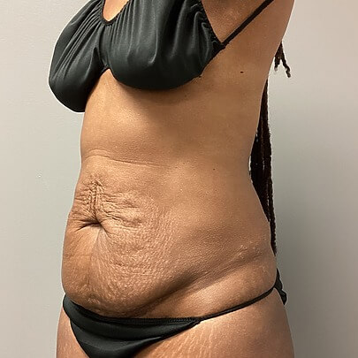 Female Sono Bello patient before AbEX excess skin removal