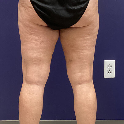 Back angle of female after Lipo thigh procedure