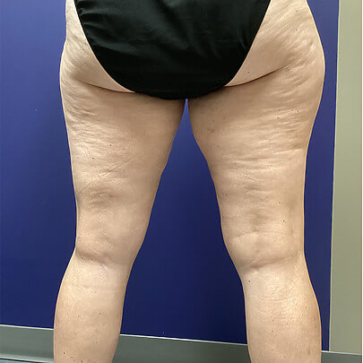 Back angle of female before Lipo thigh procedure