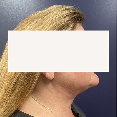 Side profile of woman after chin liposuction