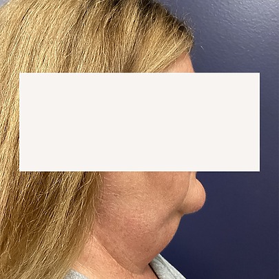 Side profile of woman before chin liposuction