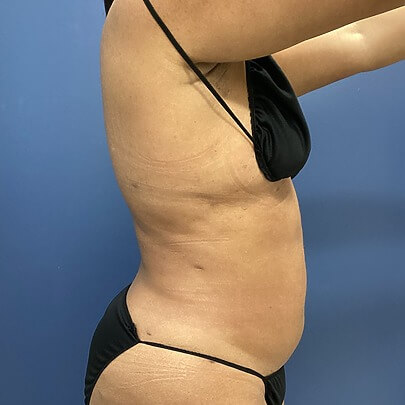 Side angle of female before Lipo stomach, back and waist procedure