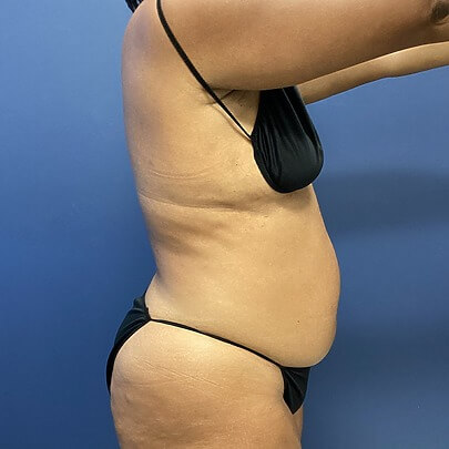 Side angle of female before Lipo stomach, back and waist procedure