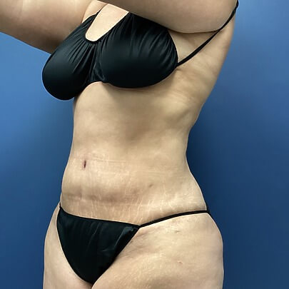 Side angle of female after AbEX stomach and waist procedure