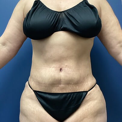 Front angle of female after AbEX stomach and waist procedure