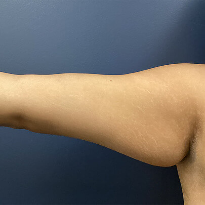 Female arm before liposuction procedure