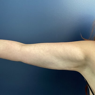 Side angle of female arms after lipo procedure